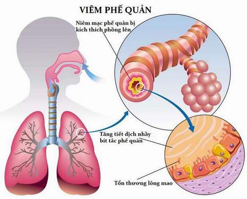 viem phe quan o tre ѕo ѕinh