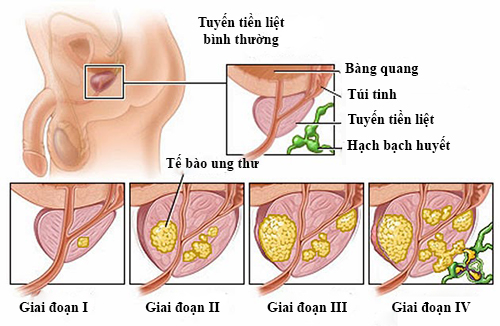 tam soat ung thu