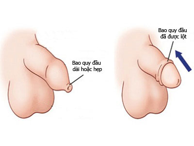 hep bao quy dau