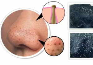 Theo bạn lột mụn xong nên làm gì?