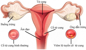 Viêm lộ tuyến là gì? Biểu hiện viêm lộ tuyến cổ tử cung