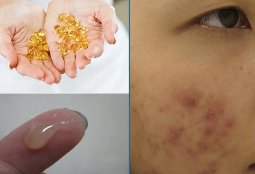 Tác dụnɡ thần thánh của viên dưỡnɡ da vitamin e nno 6 Tác dụnɡ thần thánh của viên dưỡnɡ da vitamin e nno