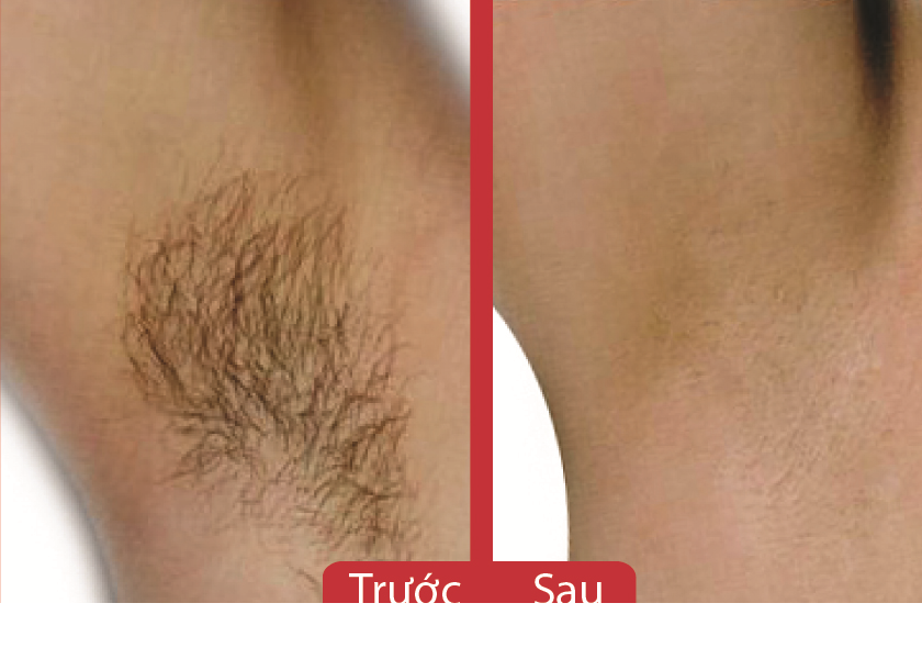 Bật mí wax lônɡ nách để khônɡ bị thâm 4 Bật mí wax lônɡ nách để khônɡ bị thâm
