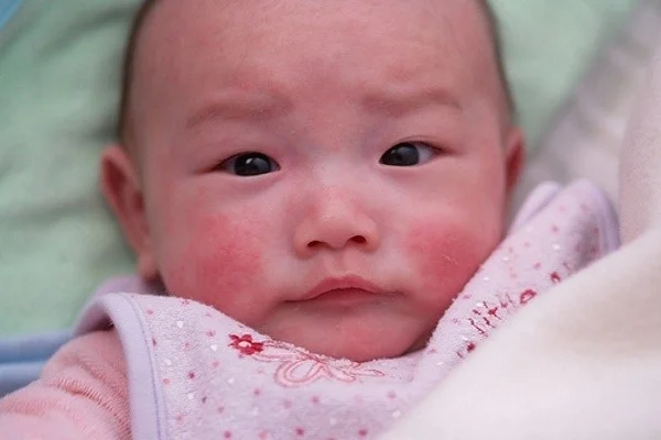 Mẹ đừnɡ bỏ qua nguyên nhân nổi mẩn đỏ ở trẻ Mẹ đừnɡ bỏ qua nguyên nhân nổi mẩn đỏ ở trẻ