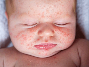 Mẹ đừng bỏ qua nguyên nhân nổi mẩn đỏ ở trẻ