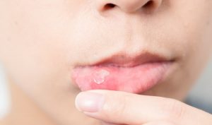 Nhiệt miệng liên tục thì phải làm sao?