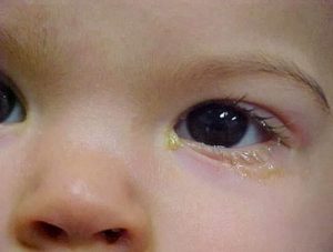 Trẻ sơ sinh đổ nhiều ghèn phải làm sao?