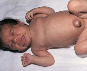 Trẻ sơ sinh bị lồi rốn nguyên nhân do đâu?