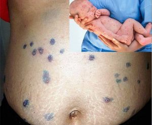 Mẹ bị thủy đậu có ảnh hưởng đến thai nhi không?