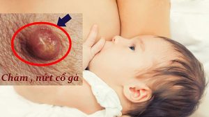 Xua tan nỗi lo nứt núm vú cho mẹ bỉm sữa