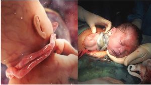 Làm gì khi thai nhi bị quấn dây rốn ở cổ?