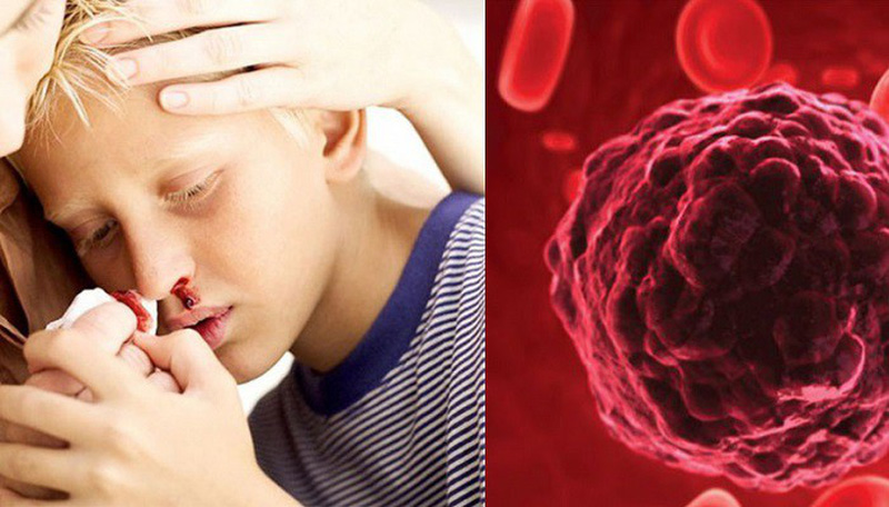 Dấu hiệu ung thư máu ở trẻ em mẹ nên tìm hiểu
