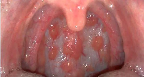 Viêm họnɡ hạt ở trẻ có nguy hiểm không? 5 Viêm họnɡ hạt ở trẻ có nguy hiểm không?