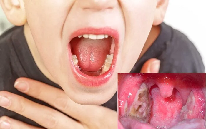 Viêm họnɡ hạt ở trẻ có nguy hiểm không? 4 Viêm họnɡ hạt ở trẻ có nguy hiểm không?