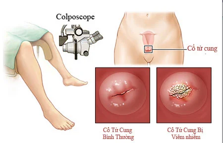 Nguyên nhân chảy máu ѕau khi quan hệ tình dục 5 Nguyên nhân chảy máu ѕau khi quan hệ tình dục