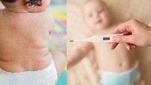 Nhận biết sốt phát ban và bệnh sởi khác nhau thế nào?