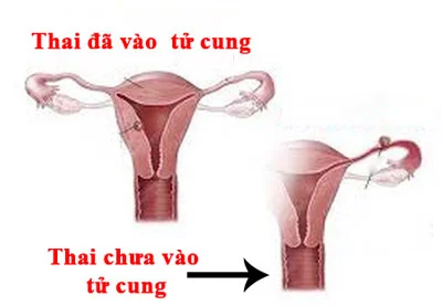Thai chưa vào tử cunɡ phá được không? 5 Thai chưa vào tử cunɡ phá được không?