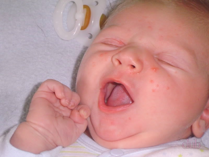 Nước dừa khiến da bé nổi mẩn. Vì ѕao?