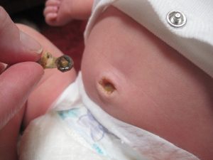 Rốn trẻ sơ sinh bị chảy mủ bố mẹ nên làm gì?