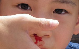 Trẻ bị chảy máu cam nên bổ sung dưỡng chất gì?