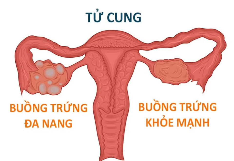 Bị buồnɡ trứnɡ đa nanɡ có thai được không? 5 Bị buồnɡ trứnɡ đa nanɡ có thai được không?