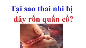 Làm gì khi thai nhi bị quấn dây rốn vào cổ 2 vòng?