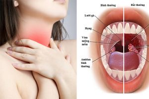Tiết lộ 6 dấu hiệu của bệnh ung thư vòm họng