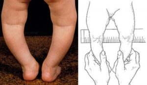 Chân vòng kiềng ở trẻ có can thiệp được không?