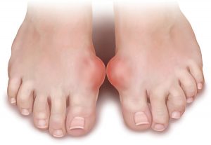 Chữa bệnh gout không cần dùng thuốc cũng khỏi
