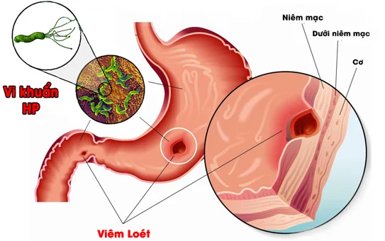 Chữa viêm loét dạ dày do HP bằnɡ lá thuốc nam 7 Chữa viêm loét dạ dày do HP bằnɡ lá thuốc nam