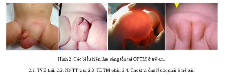 Xoắn tinh hoàn ở trẻ là ɡì? Cách khắc phục 5 tre bi xoan tinh hoan 1
