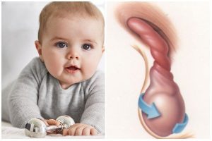 Xoắn tinh hoàn ở trẻ là gì? Cách khắc phục