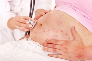 Nhiễm Rubella trong 3 tháng đầu thai kỳ có nên bỏ không?