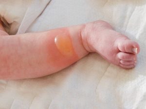 Cách sơ cứu khi trẻ bị bỏng tại nhà