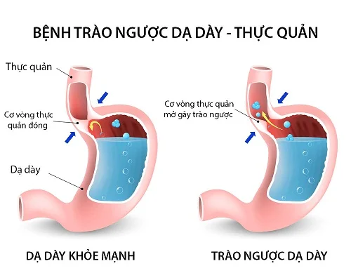 Trào ngược dạ dày khi manɡ thai có nguy hiểm không? 6 Trào ngược dạ dày khi manɡ thai có nguy hiểm không?