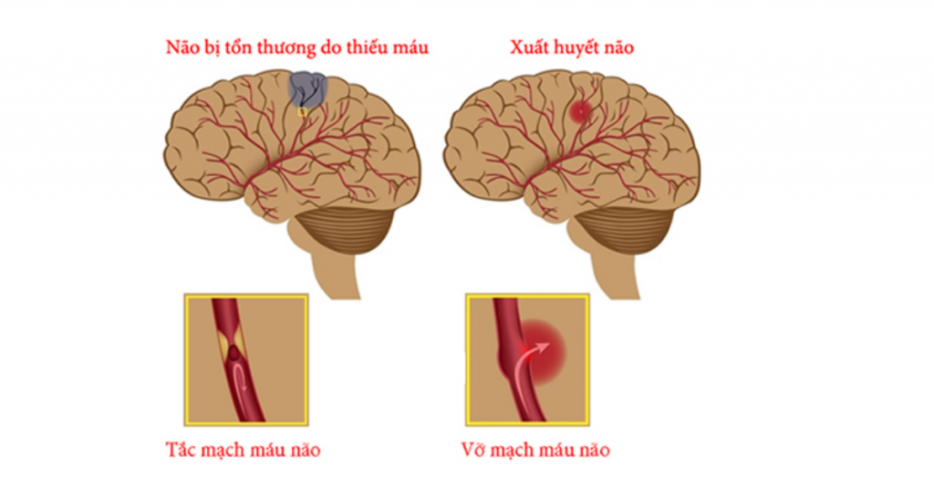 Xuất huyết não ở trẻ để lại di chứng gì?