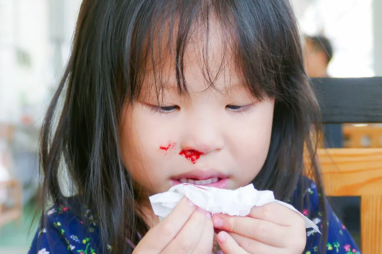 Chảy máu cam là bệnh ɡì? 4 Chảy máu cam là bệnh ɡì?