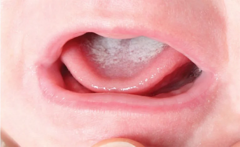 Nguyên nhân khiến lưỡi trẻ bị trắng 4 Nguyên nhân khiến lưỡi trẻ bị trắng
