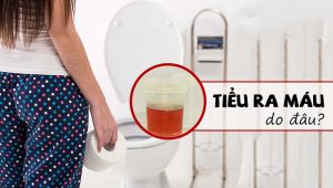 Đi tiểu ra máu là hiện tượng của bệnh gì?