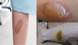 Bỏng bô xe máy bao lâu thì khỏi?