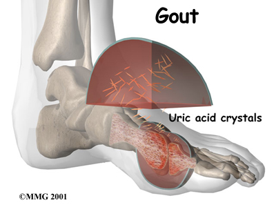 benh-gout-co-nguy-hiem-khong