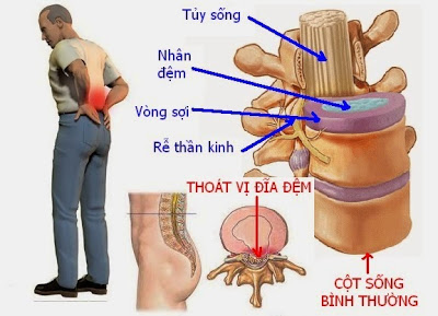 Thoat-vi-dia-dem-cot-song-co-co-chua-duoc-khong