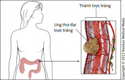 Các biểu hiện của bệnh ung thư trực tràng giai đoạn đầu