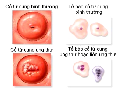 Dấu hiệu ung thư cổ tử cung