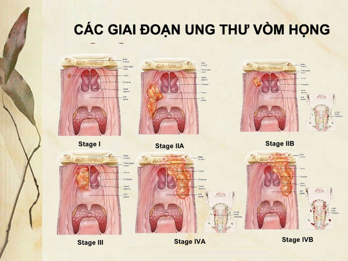 Triệu chứng của ung thư vòm họng giai đoạn cuối