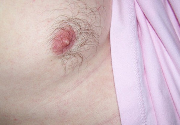 dau-hieu-ung-thu-vu-o-nam-gioi