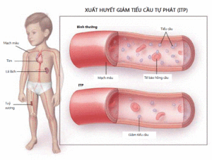 giam-tieu-cau-la-gi