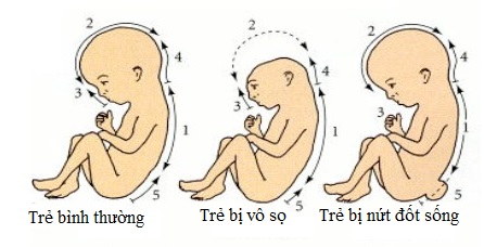 thieu-axit-folic