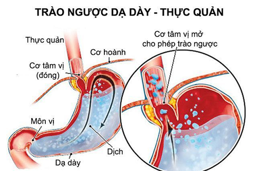 trao-nguoc-da-day