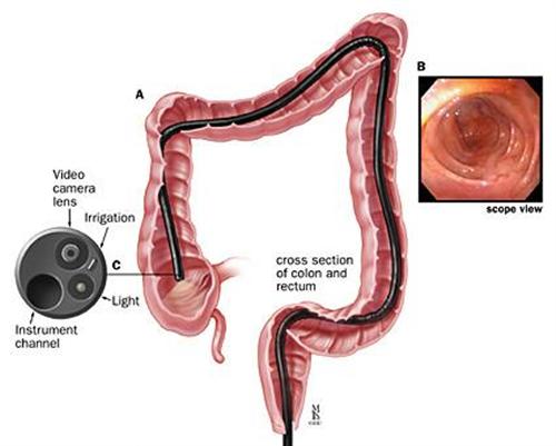 4 biểu hiện của ung thư đại tràng giai đoạn cuối